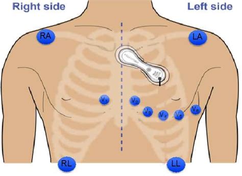 Electrode placement layout of Holter Monitor (blue electrodes are for ...