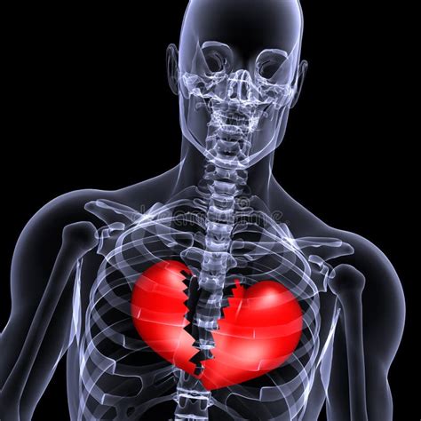 Skeleton X-Ray Broken Heart 1 Royalty Free Stock Photo - Image: 1865075