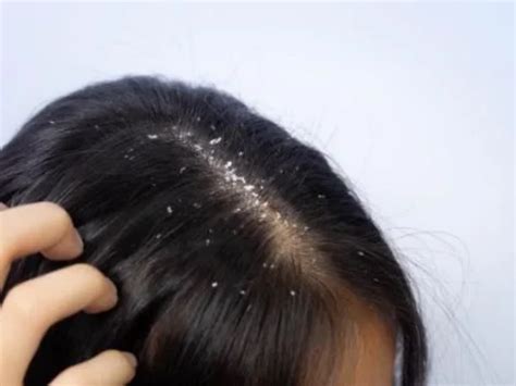 Seborrheic Dermatitis Scalp Hair Loss