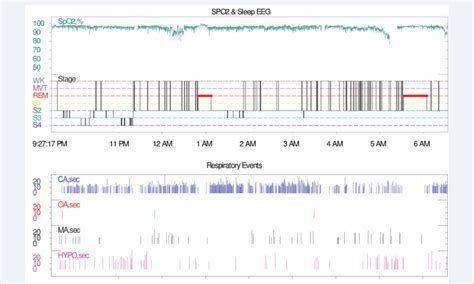 Nocturnal Polysomnography data -showing respiratory events in our... | Download Scientific Diagram