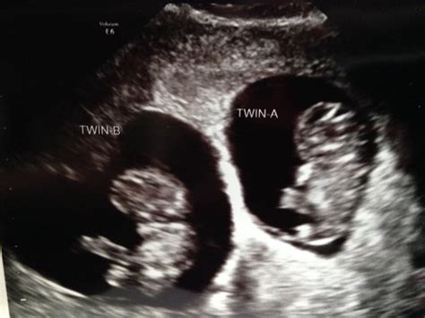 any 8 week twin ultrasound pics ? - Page 3 - BabyCenter