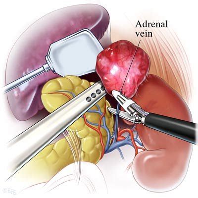 Diseases of the Adrenal Gland — Suncoast Surgical Associates