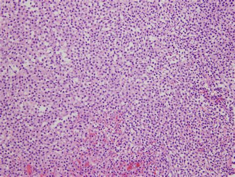 Histopathology revealed pituitary adenoma composed of monomorphous... | Download Scientific Diagram