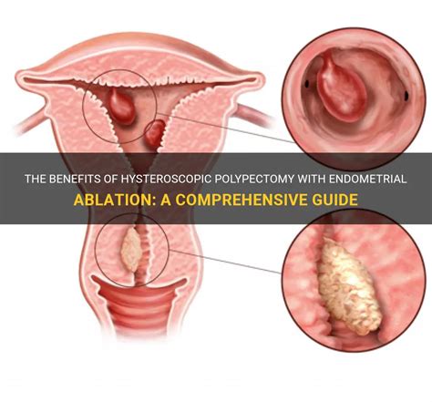 The Benefits Of Hysteroscopic Polypectomy With Endometrial Ablation: A Comprehensive Guide | MedShun