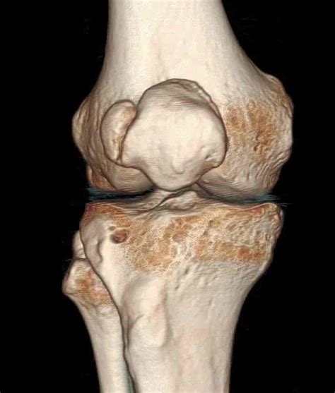 patella bipartita – Store medisinske leksikon