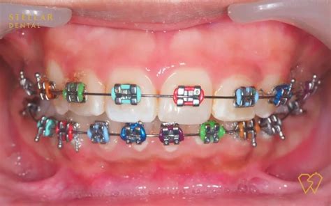 Braces Colors: Top Picks For 2023 - Stellar Dental