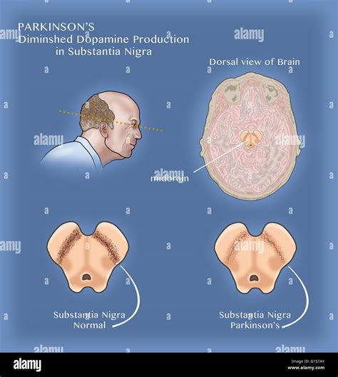 Illustration showing degeneration of dopaminergic neurons in the substantia nigra of the ...