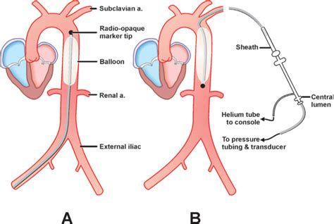 Intra-Aortic Balloon Pump (IABP) Placement | Thoracic Key | Balloon ...