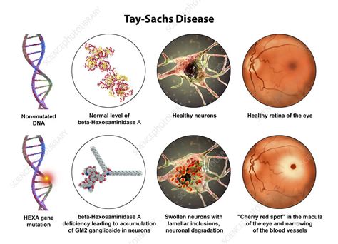 Tay-Sachs disease, illustration - Stock Image - F034/4373 - Science ...