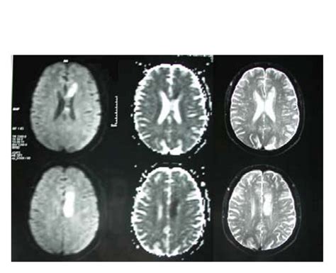 The first MRI shows an infarct in left centrum semiovale near the left ...