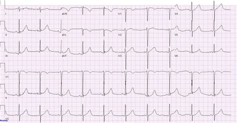 Myocardial bridge: bridging the differential diagnosis | BMJ Case Reports