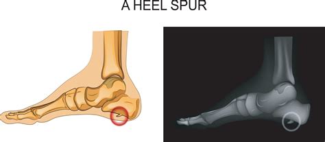 Bone And Heel Spur Treatment In Chicago Il Sports Medicine Podiatrist | Free Download Nude Photo ...