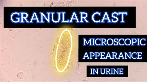 Granular Cast in Urine | Microscopic Appearance | Short Video | @pathologymaster7044 - YouTube