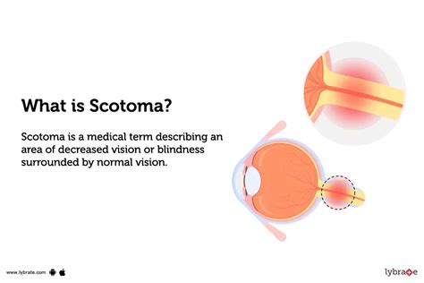 Scotoma: Causes, Symptoms, Treatment and Cost