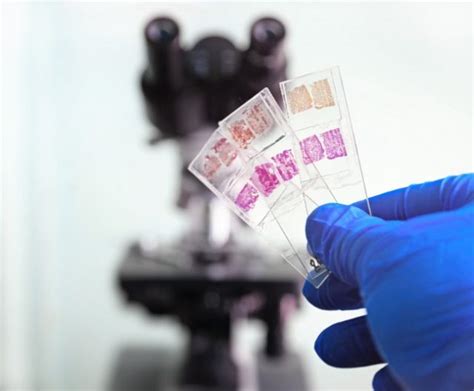 Tissue Biopsy: What to Expect - Cancer Therapy Advisor