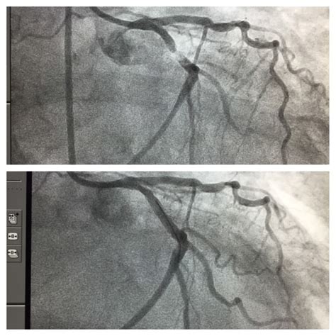 Cardiac catherization(angiogram)/stent - Hamilton Cardiology Associates ...