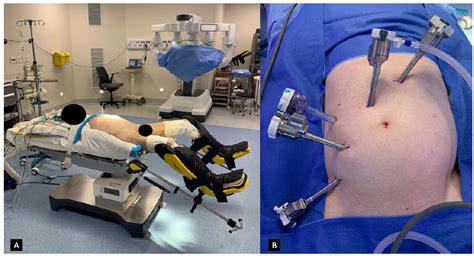 SciELO - Brasil - Technical essential aspects in robotic colorectal surgery: mastering the Da ...