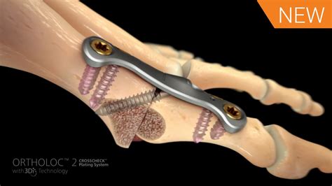 1st MTP Fusion Animation featuring ORTHOLOC™ 2 CROSSCHECK™ [016676A] - VLC