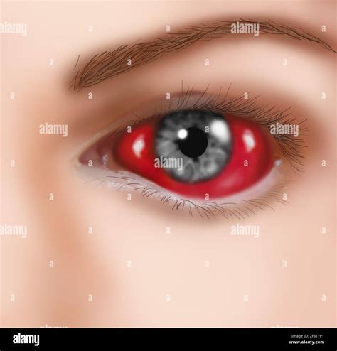 Eye Hemorrhage Anatomy