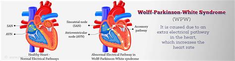 Wolff-Parkinson-White Syndrome (WPW) - Causes, Symptoms, Diagnosis, Treatment & Prevention