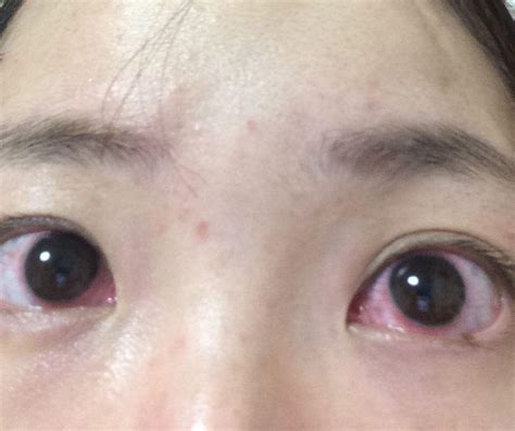 Skillful treatment of foreign bodies in eyes - Think Recipe