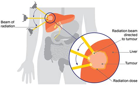 Radiation Therapy for Primary Liver Cancer | Cancer Council NSW