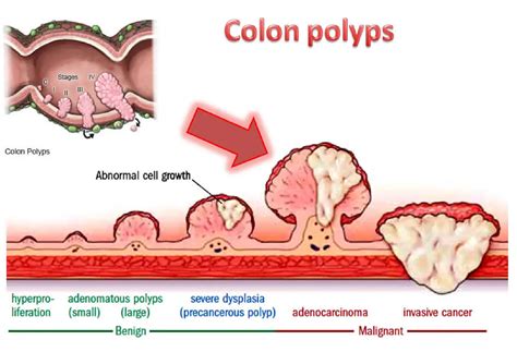 Colon Polyp Size And Type Charts, 55% OFF