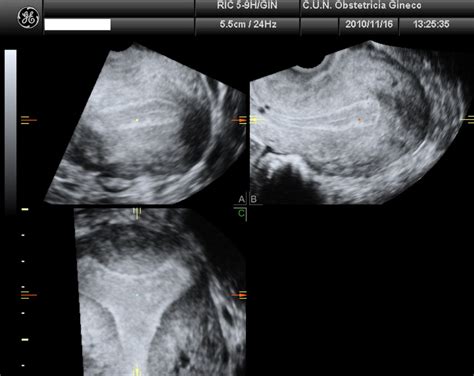 Three-dimensional transvaginal ultrasound from an arcuate uterus.... | Download Scientific Diagram