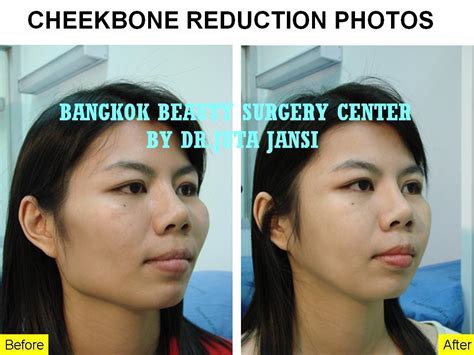 Bangkok Thailand Feminine Surgery