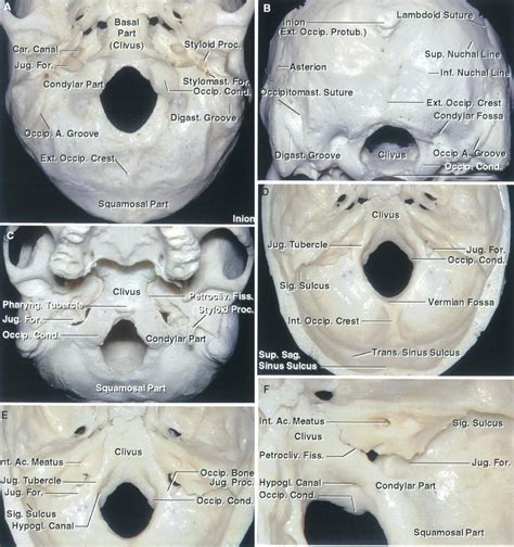 Foramen Magnum | The Neurosurgical Atlas, by Aaron Cohen-Gadol, M.D.