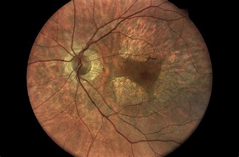 Macular Dystrophy - Causes, Types, Treatment