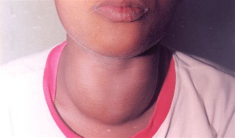 Smooth, diffuse thyroid swelling. Figure 2. Onycholysis (Plummer's nails). | Download Scientific ...