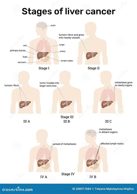 Stages of liver cancer stock vector. Illustration of tumor - 208917684