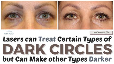 Treating Dark Circles - How Lasers can Treat Some Causes, and Other Treatments to Improve Color ...