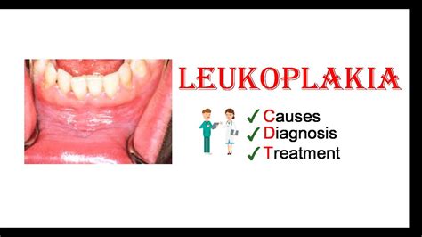 Leukoplakia - Causes, Diagnosis & Treatment - YouTube