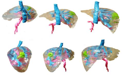 Medical Student Creates Patient-Specific 3D Printed Liver Model for ...