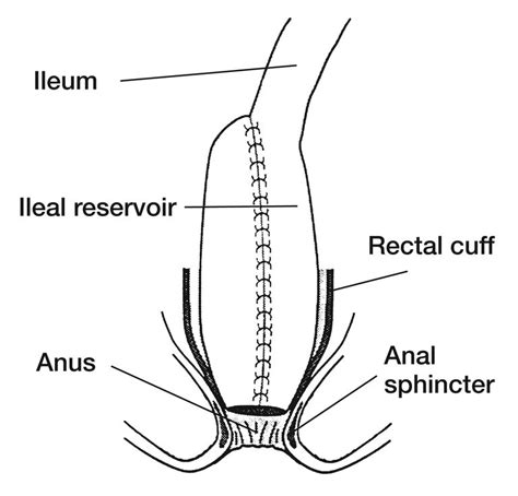 The Differences Between an Ileostomy and a J-Pouch