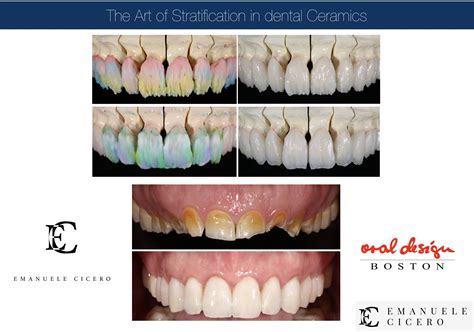 What are dental veneers: advantages, disadvantages, duration - Emanuele Cicero