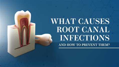 Root Canal Infection - Cause and Prevention - Springvale Dental Clinic