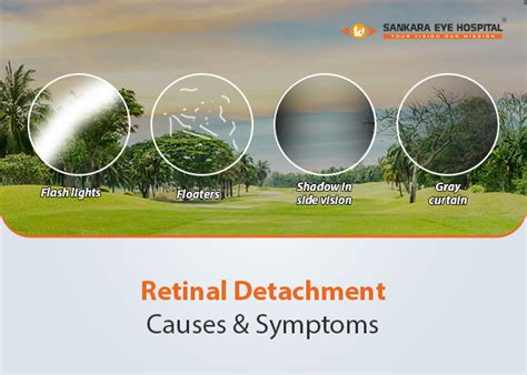 Retinal Detachment: Causes & Symptoms | Sankara