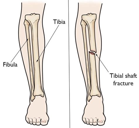 Tibial shaft fracture causes, types, symptoms, diagnosis, treatment & prognosis