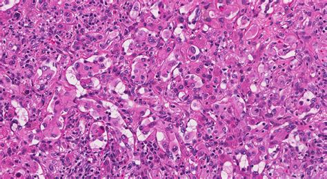 Epithelioid hemangioendothelioma | MyPathologyReport.ca