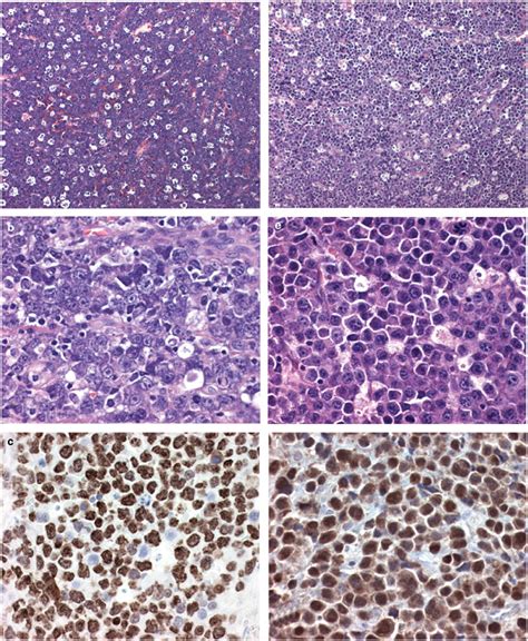 Morphologic features and proliferation index of plasmablastic lymphoma... | Download Scientific ...