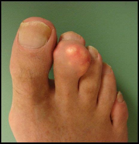 What Does Gout Look Like In Foot and Treatment