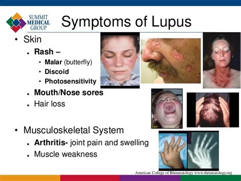 Lupus Rash On Nose