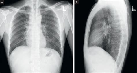 Normal Lateral Chest Xray