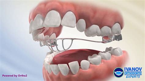 tongue thrust treatment for adults - jacobos-mezquita