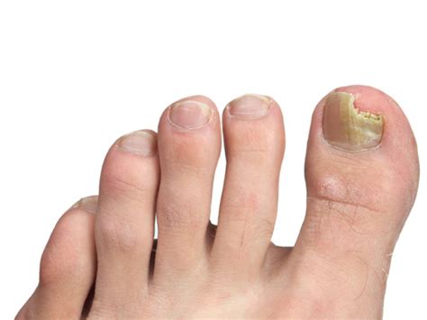 Nail Abnormalities | McLean & Woodbridge VA