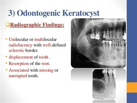 Odontogenic keratocyst | Odontología