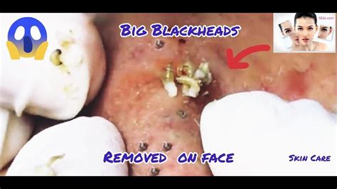 Cystic Acne Extraction This Week, Blackheads Removal #3 - YouTube